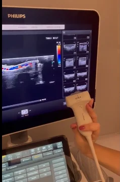 Mão da médica segurando o transdutor diante do aparelho Philips, com Doppler colorido na tela