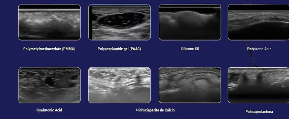 Grade de oito imagens de ultrassom identificando preenchedores diferentes