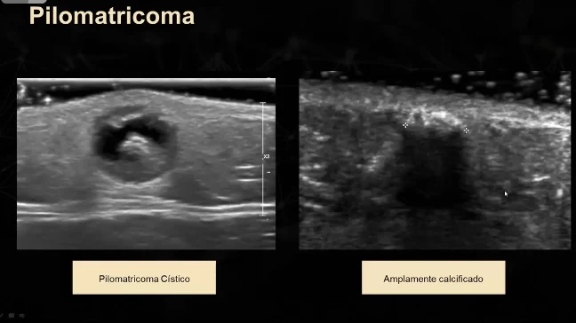Dois exames da mesma entidade lado a lado, um rotulado como pilomatricoma cistico e o outro como amplamente calcificado