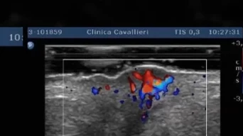 Exame com Doppler colorido mostrando vascularizacao dentro de uma lesao
