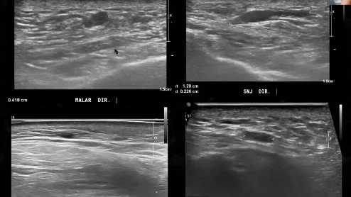 Quatro exames da mesma face identificados por ponto, malar direito, sulco nasojugal, temporal esquerdo e zigoma, cada um com medida em centimetros