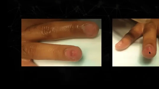 Slide da aula com o titulo tumor glomico e duas fotografias clinicas do mesmo dedo em angulos diferentes
