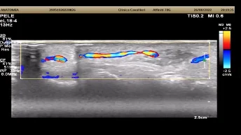 Exame do terco inferior da face com Doppler colorido desenhando o trajeto dos vasos