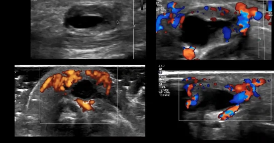 Quatro exames com Doppler colorido mostrando padroes de vascularizacao diferentes em torno de lesoes escuras