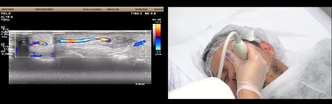 Tela dividida: a esquerda o Doppler colorido mostrando os vasos daquela face em azul e laranja, a direita o transdutor apoiado sobre o rosto do modelo no mesmo instante