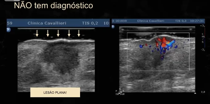 Slide da aula com o titulo nao tem diagnostico, um exame com setas apontando a superficie e a marcacao lesao plana, ao lado do mesmo ponto com Doppler colorido
