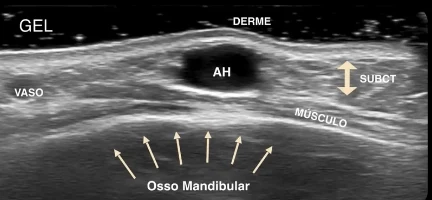Ultrassom anotado mostrando gel, derme, o depósito de ácido hialurônico, vaso, subcutâneo, músculo e o osso mandibular