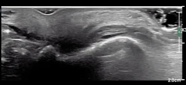 Ultrassom mostrando migração de ácido hialurônico