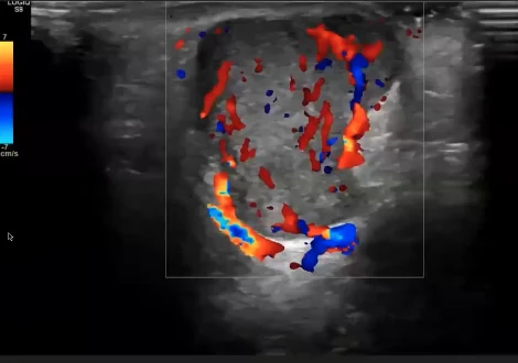 Ultrassom com Doppler colorido mostrando nódulo sólido intensamente vascularizado na face