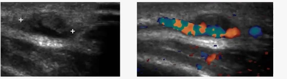 Doppler colorido sobre a lesão da têmpora, com fluxo visível no interior