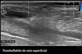 Doppler sobre o cordão doloroso da face, após preenchimento com Sculptra