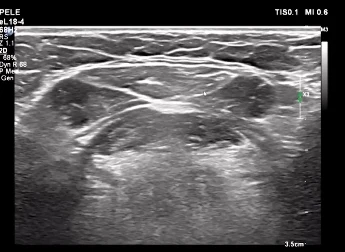 Exame de ultrassom da região submentual e cervical